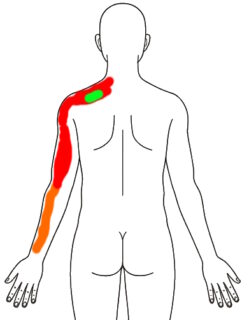 2026-0309　朝の痛み